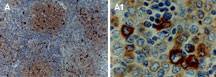 TRAF1 Antibody - Formalin-fixed, paraffin-embedded human lymphoma tissue section stained for TRAF1 expression using Polyclonal Antibody to TRAF1 at 1:2000. Hematoxylin-Eosin counterstain. A1 is a higher magnification of A.