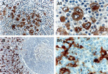 TRAF1 Antibody - Formalin-fixed, paraffin-embedded human tissue sections stained for TRAF1 expression using Polyclonal Antibody to TRAF1 at 1:2000. Hematoxylin-Eos in counterstain. A, A1: Formalin-fixed, paraffin-embedded human lymphoma tissue section stained for TRAF1 expression using Polyclonal Antibody to TRAF1 at 1:2000. Hematoxylin-Eos in counterstain. A, Hodgkins Disease, the Reed-Sternberg cells are positive for TRAF1 expression. B, lymph node, dendritic-like cells are positive for TRAF1 expression. A1 and B1 are higher magnifications from A and B, respectively.