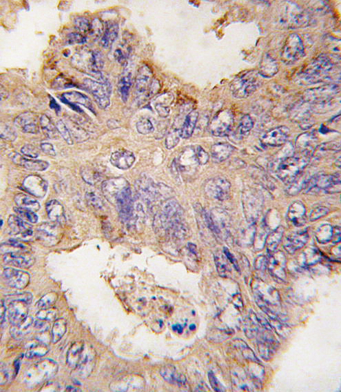 TRAF2 Antibody - Formalin-fixed and paraffin-embedded human colon carcinoma tissue reacted with TRAF2 antibody , which was peroxidase-conjugated to the secondary antibody, followed by DAB staining. This data demonstrates the use of this antibody for immunohistochemistry; clinical relevance has not been evaluated.