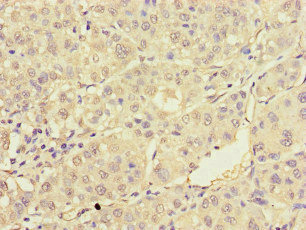 TRAF2 Antibody - Immunohistochemistry of paraffin-embedded human liver cancer at dilution of 1:100