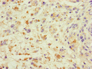 TRAF2 Antibody - Immunohistochemistry of paraffin-embedded human melanoma cancer at dilution of 1:100