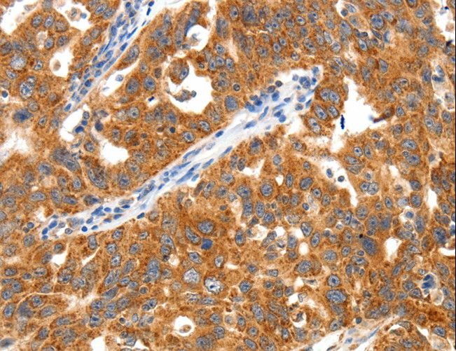 TRAF3 Antibody - Immunohistochemistry of paraffin-embedded Human ovarian cancer using TRAF3 Polyclonal Antibody at dilution of 1:40.