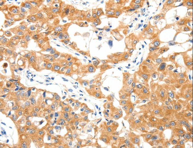TRAF3 Antibody - Immunohistochemistry of paraffin-embedded Human lung cancer using TRAF3 Polyclonal Antibody at dilution of 1:40.