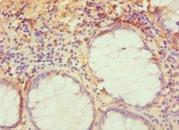 TRAF3IP2 / ACT1 Antibody - Immunohistochemistry of paraffin-embedded human colon cancer using antibody at 1:100 dilution.
