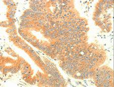 TRAF3IP2 / ACT1 Antibody - Immunohistochemistry of paraffin-embedded Human colon cancer using TRAF3IP2 Polyclonal Antibody at dilution of 1:30.
