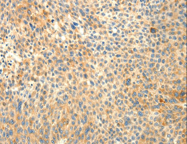 TRAF3IP2 / ACT1 Antibody - Immunohistochemistry of paraffin-embedded Human liver cancer using TRAF3IP2 Polyclonal Antibody at dilution of 1:30.