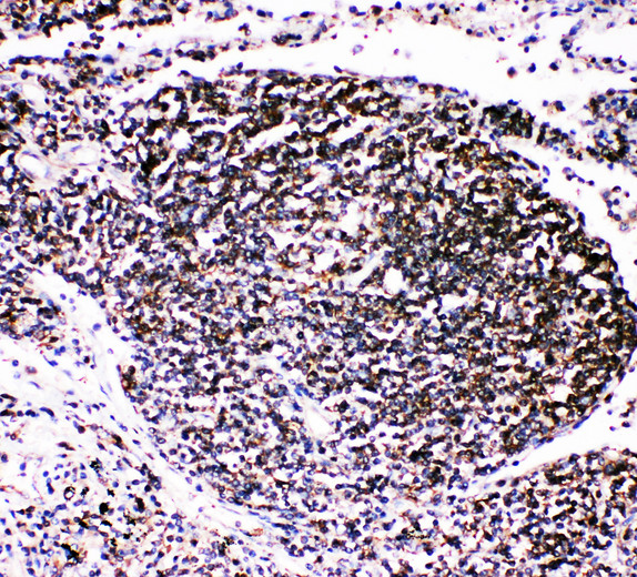 TRAF4 Antibody - CART1 / TRAF4 antibody. IHC(P): Human Lung Cancer Tissue.