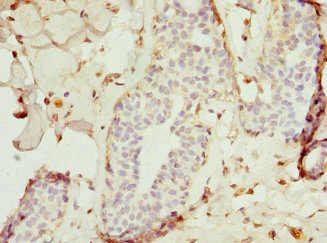 TRAF4 Antibody - Immunohistochemistry of paraffin-embedded human breast cancer tissue at dilution 1:100