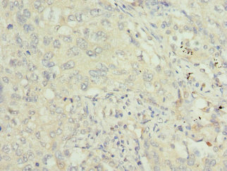 TRAF4 Antibody - Immunohistochemistry of paraffin-embedded human lung cancer tissue at dilution 1:100