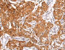 TRAF5 Antibody - Immunohistochemistry of paraffin-embedded Human lung cancer using TRAF5 Polyclonal Antibody at dilution of 1:30.