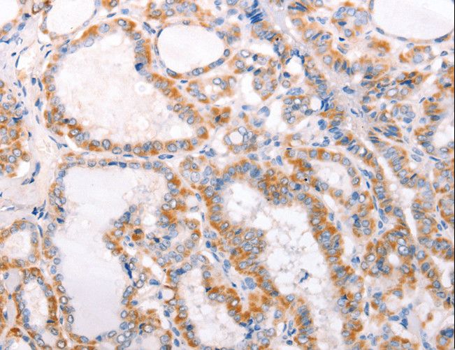TRAF5 Antibody - Immunohistochemistry of paraffin-embedded Human thyroid cancer using TRAF5 Polyclonal Antibody at dilution of 1:30.