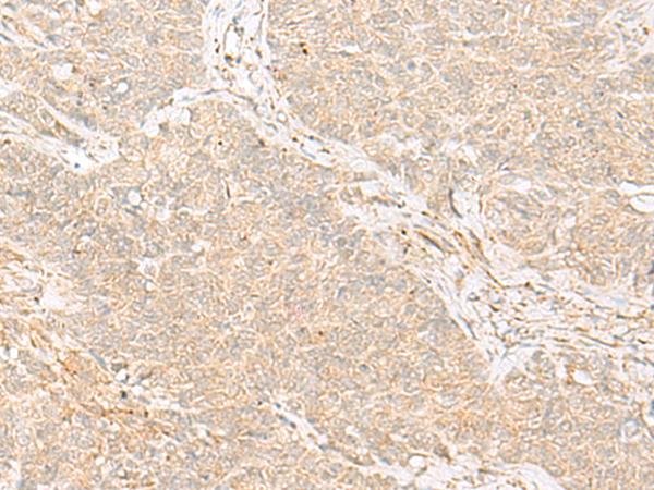 TRAF6 Antibody - Immunohistochemistry of paraffin-embedded Human ovarian cancer tissue  using TRAF6 Polyclonal Antibody at dilution of 1:30(×200)