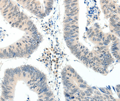 TRAF7 Antibody - Immunohistochemistry of paraffin-embedded human colon cancer tissue.