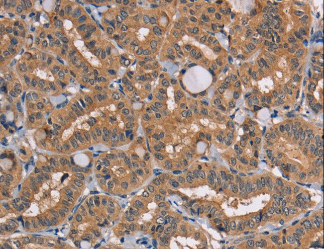 TRAFD1 / FLN29 Antibody - Immunohistochemistry of paraffin-embedded Human thyroid cancer using TRAFD1 Polyclonal Antibody at dilution of 1:20.