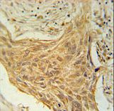TRAG3 / CSAG2 Antibody - CSAG2 Antibody immunohistochemistry of formalin-fixed and paraffin-embedded human lung carcinoma followed by peroxidase-conjugated secondary antibody and DAB staining.
