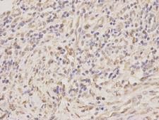TRAIL-R4 / DCR2 Antibody - Immunohistochemistry of paraffin-embedded human stomach cancer using TNFRSF10D antibody at dilution of 1:200 (400x lens).