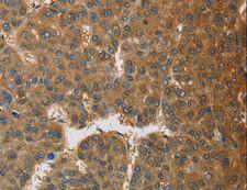 TRAIL-R4 / DCR2 Antibody - Immunohistochemistry of paraffin-embedded Human thyroid cancer using TNFRSF10D Polyclonal Antibody at dilution of 1:60.