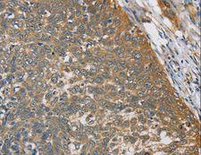 TRAIL-R4 / DCR2 Antibody - Immunohistochemistry of paraffin-embedded Human thyroid cancer using TNFRSF10D Polyclonal Antibody at dilution of 1:40.