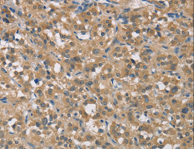 TRAIL-R4 / DCR2 Antibody - Immunohistochemistry of paraffin-embedded Human thyroid cancer using TNFRSF10D Polyclonal Antibody at dilution of 1:40.