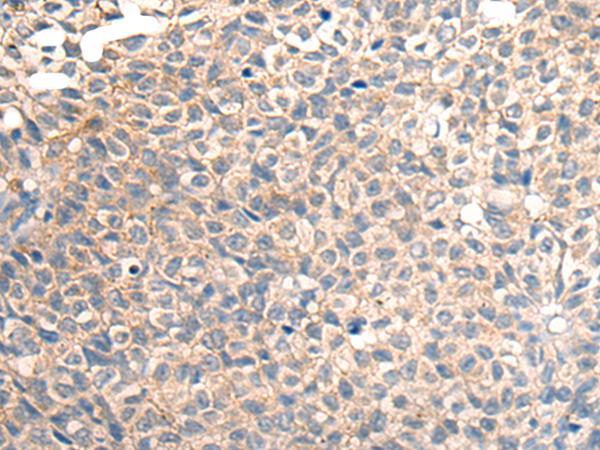 TRAIL-R4 / DCR2 Antibody - Immunohistochemistry of paraffin-embedded Human ovarian cancer tissue  using TNFRSF10D Polyclonal Antibody at dilution of 1:30(×200)