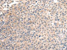 TRAIL-R4 / DCR2 Antibody - Immunohistochemistry of paraffin-embedded Human ovarian cancer tissue  using TNFRSF10D Polyclonal Antibody at dilution of 1:30(×200)