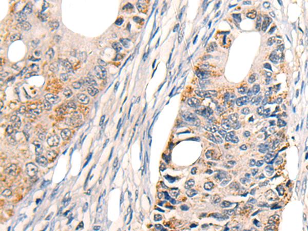 TRAIL-R4 / DCR2 Antibody - Immunohistochemistry of paraffin-embedded Human colorectal cancer tissue  using TNFRSF10D Polyclonal Antibody at dilution of 1:30(×200)