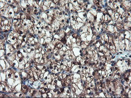 TRAIP / TRIP Antibody - IHC of paraffin-embedded Carcinoma of Human kidney tissue using anti-TRAIP mouse monoclonal antibody. (Heat-induced epitope retrieval by 10mM citric buffer, pH6.0, 100C for 10min).