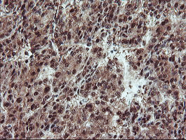 TRAIP / TRIP Antibody - IHC of paraffin-embedded Carcinoma of Human liver tissue using anti-TRAIP mouse monoclonal antibody. (Heat-induced epitope retrieval by 10mM citric buffer, pH6.0, 100C for 10min).
