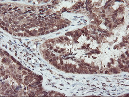 TRAIP / TRIP Antibody - IHC of paraffin-embedded Adenocarcinoma of Human ovary tissue using anti-TRAIP mouse monoclonal antibody. (Heat-induced epitope retrieval by 10mM citric buffer, pH6.0, 100C for 10min).