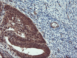 TRAIP / TRIP Antibody - IHC of paraffin-embedded Adenocarcinoma of Human endometrium tissue using anti-TRAIP mouse monoclonal antibody. (Heat-induced epitope retrieval by 10mM citric buffer, pH6.0, 100C for 10min).