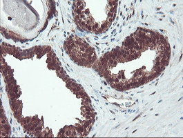 TRAIP / TRIP Antibody - IHC of paraffin-embedded Carcinoma of Human prostate tissue using anti-TRAIP mouse monoclonal antibody. (Heat-induced epitope retrieval by 10mM citric buffer, pH6.0, 100C for 10min).
