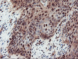 TRAIP / TRIP Antibody - IHC of paraffin-embedded Carcinoma of Human bladder tissue using anti-TRAIP mouse monoclonal antibody. (Heat-induced epitope retrieval by 10mM citric buffer, pH6.0, 100C for 10min).