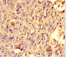 TRAK1 Antibody - Immunohistochemistry of paraffin-embedded human melanoma using TRAK1 Antibody at dilution of 1:100
