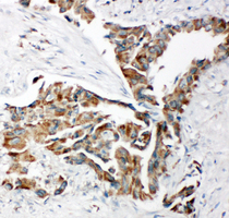TRAM1 Antibody - TRAM1 antibody. IHC(P): Human Lung Cancer Tissue.