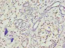TRAM2 Antibody - Immunohistochemistry of paraffin-embedded human pancreatic cancer using antibody at dilution of 1:100.