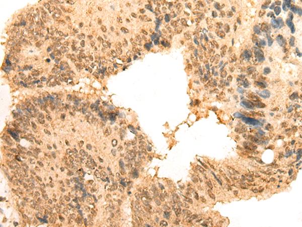 Translokin / CEP57 Antibody - Immunohistochemistry of paraffin-embedded Human colorectal cancer tissue  using CEP57 Polyclonal Antibody at dilution of 1:30(×200)