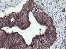 TRAP1 / HSP75 Antibody - IHC of paraffin-embedded Carcinoma of Human pancreas tissue using anti-TRAP1 mouse monoclonal antibody.