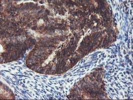 TRAP1 / HSP75 Antibody - IHC of paraffin-embedded Adenocarcinoma of Human endometrium tissue using anti-TRAP1 mouse monoclonal antibody.