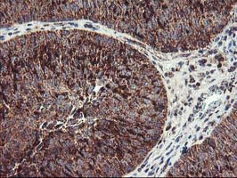 TRAP1 / HSP75 Antibody - IHC of paraffin-embedded Carcinoma of Human bladder tissue using anti-TRAP1 mouse monoclonal antibody.