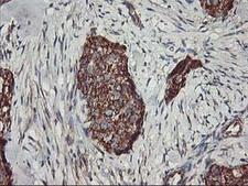 TRAP1 / HSP75 Antibody - IHC of paraffin-embedded Adenocarcinoma of Human breast tissue using anti-TRAP1 mouse monoclonal antibody.