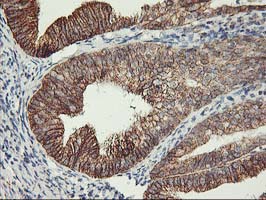 TRAP1 / HSP75 Antibody - IHC of paraffin-embedded Adenocarcinoma of Human endometrium tissue using anti-TRAP1 mouse monoclonal antibody.