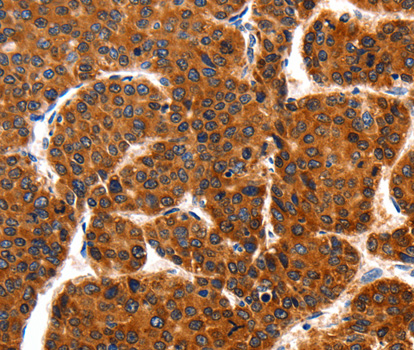 TRAP1 / HSP75 Antibody - Immunohistochemistry of paraffin-embedded human liver cancer tissue.