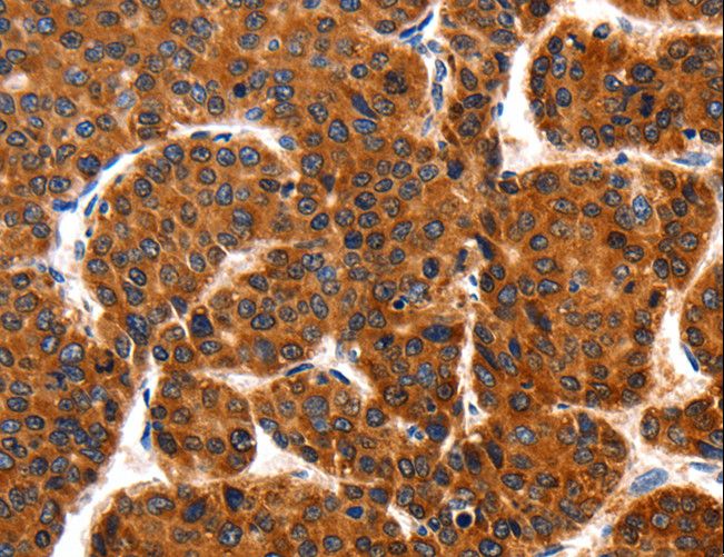 TRAP1 / HSP75 Antibody - Immunohistochemistry of paraffin-embedded Human liver cancer using TRAP1 Polyclonal Antibody at dilution of 1:100.