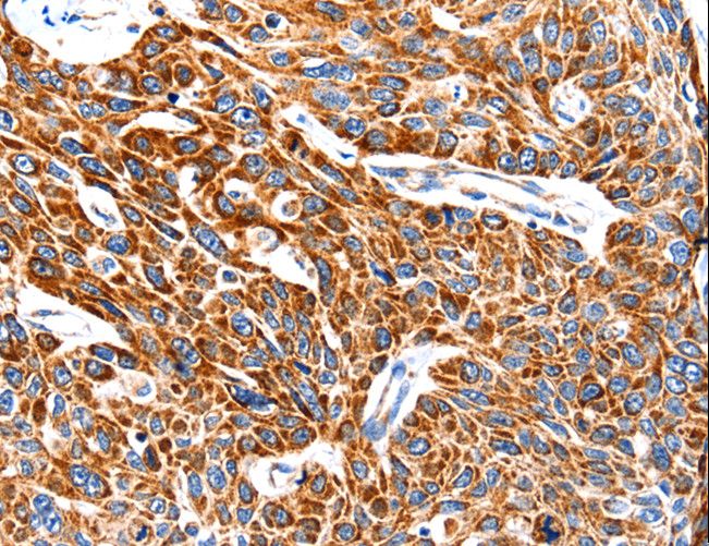 TRAP1 / HSP75 Antibody - Immunohistochemistry of paraffin-embedded Human esophagus cancer using TRAP1 Polyclonal Antibody at dilution of 1:100.