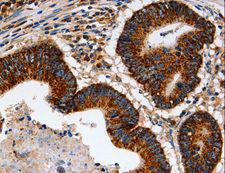 TRAP1 / HSP75 Antibody - Immunohistochemistry of paraffin-embedded Human colon cancer using TRAP1 Polyclonal Antibody at dilution of 1:60.