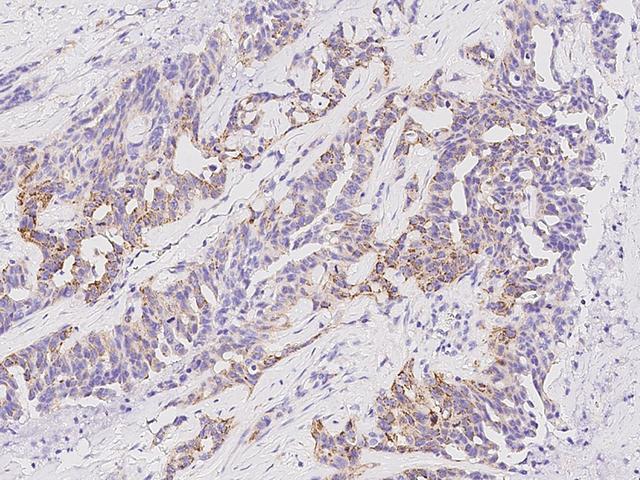 TRAP1 / HSP75 Antibody - Immunochemical staining of human TRAP1 in human pancreatic carcinoma with rabbit polyclonal antibody at 1:1000 dilution, formalin-fixed paraffin embedded sections.