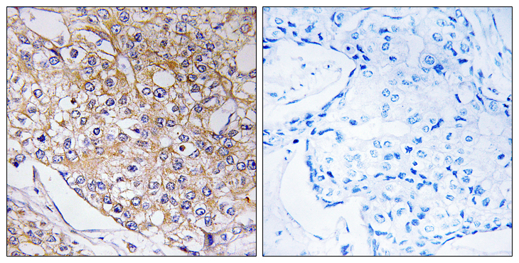 TRAPPC1 / MUM2 Antibody - Immunohistochemistry analysis of paraffin-embedded human breast carcinoma tissue, using TRAPPC1 Antibody. The picture on the right is blocked with the synthesized peptide.