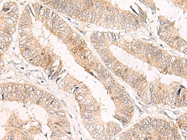 TRAPPC1 / MUM2 Antibody - Immunohistochemistry of paraffin-embedded Human colorectal cancer tissue  using TRAPPC1 Polyclonal Antibody at dilution of 1:50(×200)