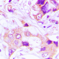 TRAPPC3 Antibody - Immunohistochemical analysis of TRAPPC3 staining in human lung cancer formalin fixed paraffin embedded tissue section. The section was pre-treated using heat mediated antigen retrieval with sodium citrate buffer (pH 6.0). The section was then incubated with the antibody at room temperature and detected using an HRP conjugated compact polymer system. DAB was used as the chromogen. The section was then counterstained with hematoxylin and mounted with DPX.