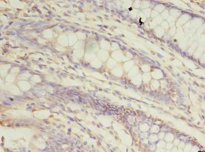TRAPPC3 Antibody - Immunohistochemistry of paraffin-embedded human colon cancer using antibody at dilution of 1:100.